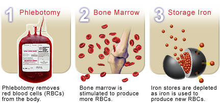 Phlebotomy reduces iron stores